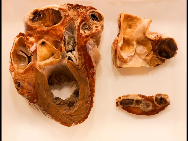 Aneurysmal dilatation of the entire coronary vascular tree