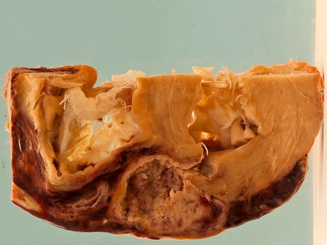 Sequelae of myocardial infarction