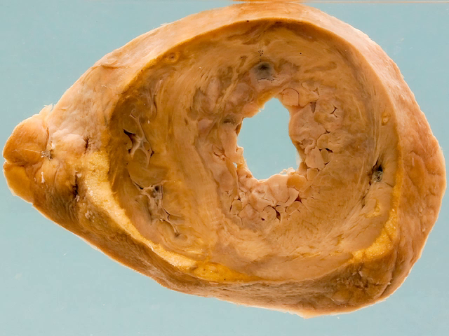 Myocardial infarct