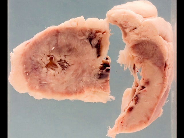 Acute myocardial infarction