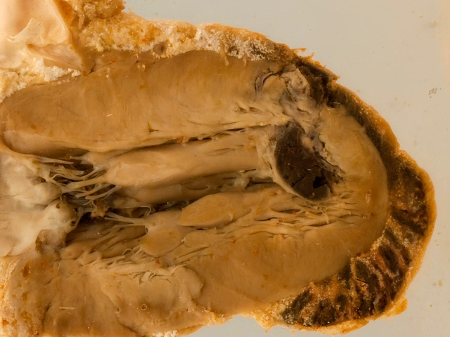 Cardiac rupture following myocardial infarction