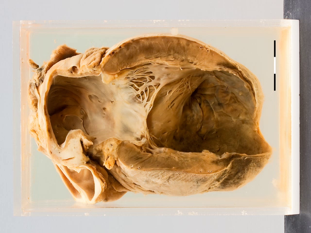 Left ventricular aneurysm
