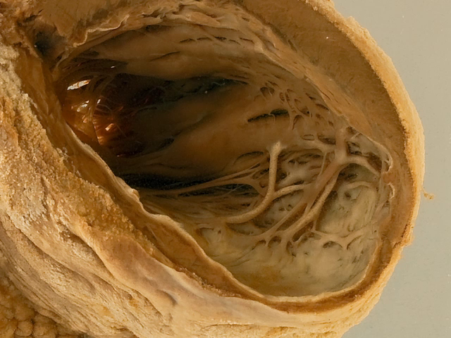 Myocardial fibrosis following infarction