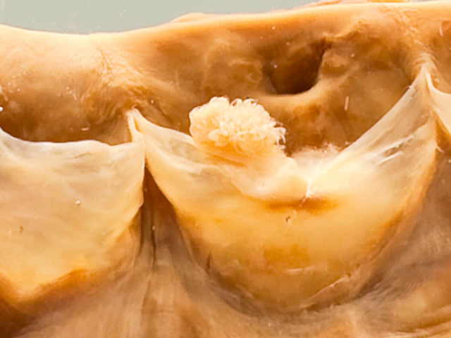 Polypoid lesions of the cardiac valves