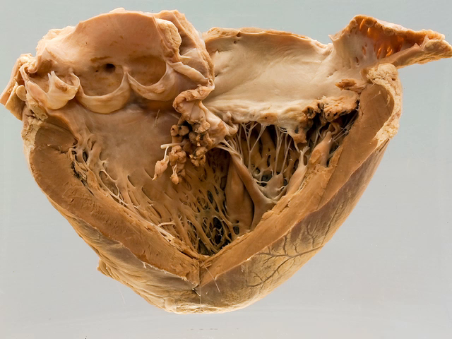 Subacute bacterial endocarditis