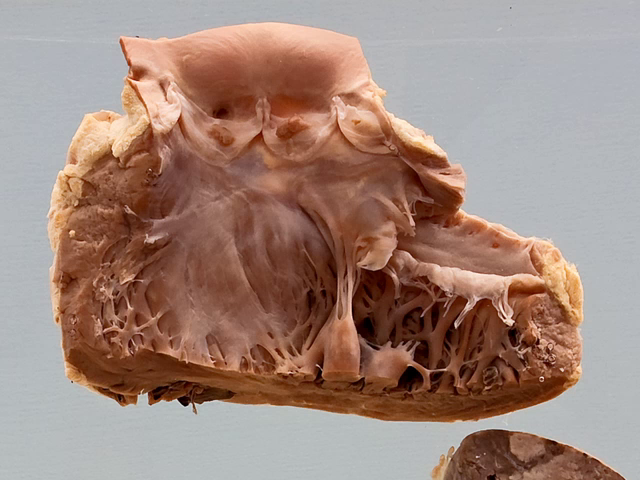 Nonbacterial thrombotic endocarditis (Marantic)