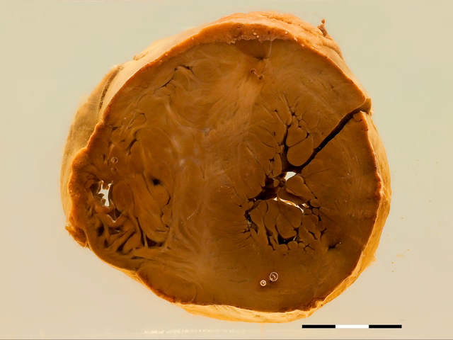 Cardiac manifestations of Von Gierke's disease