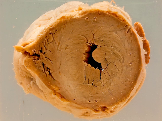Concentric hypertrophy of the left ventricle