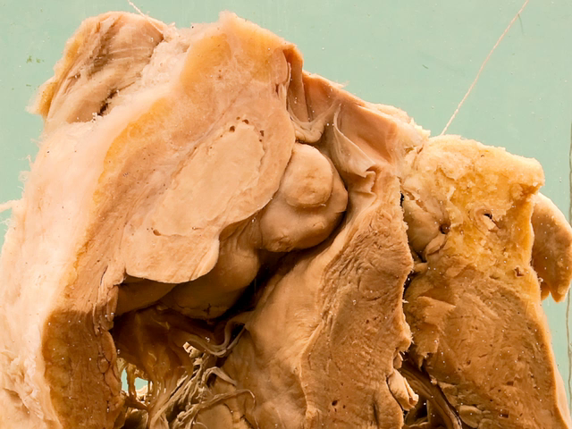 Syphilitic gumma of the right ventricle