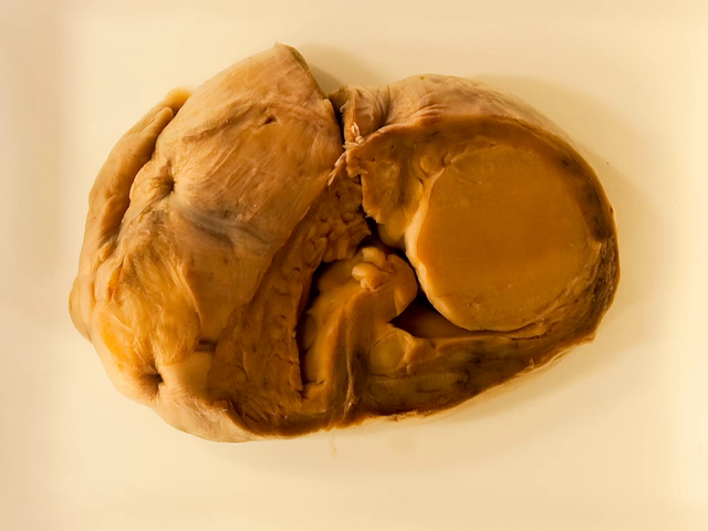 Congenital rhabdomyoma