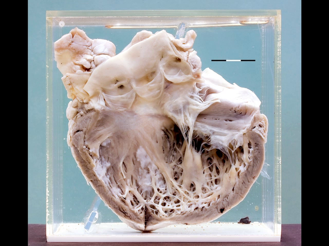 Heart in carcinoid syndrome