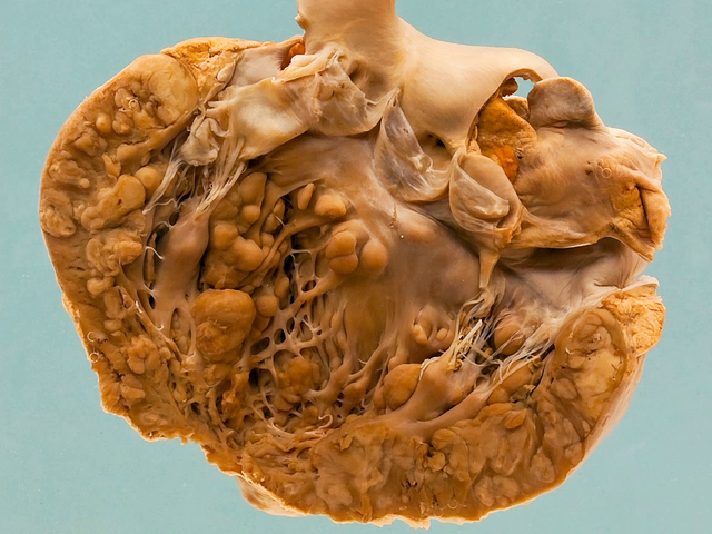 Metastatic sarcoma