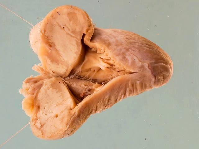 Tuberculoma of the right atrium