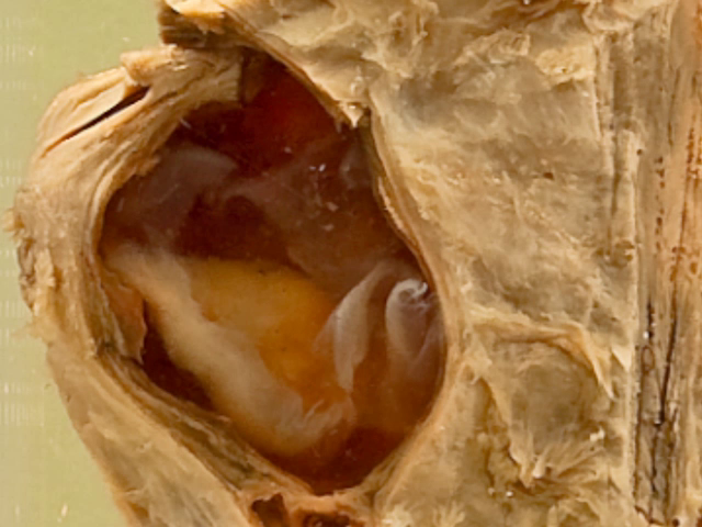 Hydatid cysts (Heart)