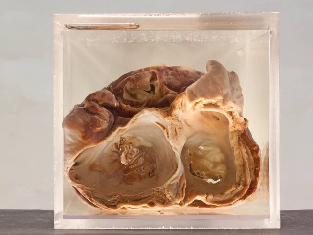 Mitral stenosis (valvotomy)