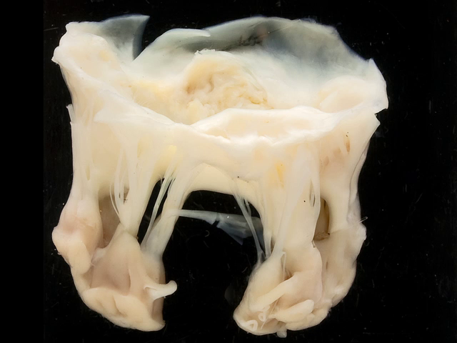Mitral stenosis