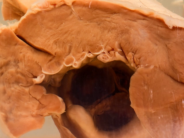 Bacterial endocarditis on a porcine heterograft valve