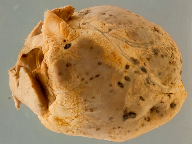 Pericardial leukaemic deposits