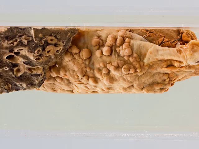 Secondary carcinoma of the pericardium