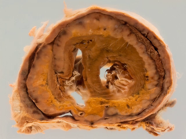 Malignant pericarditis