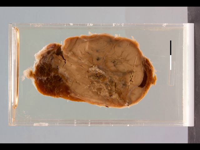 Papillary carcinoma