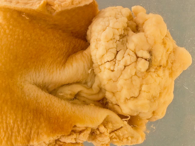 Squamous carcinoma of the vulva