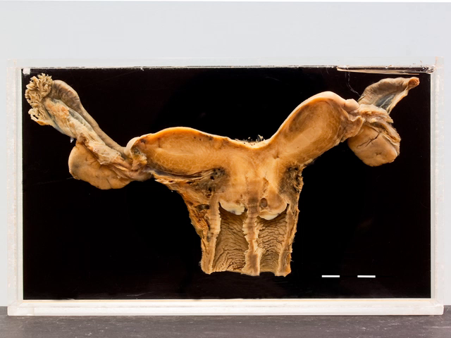 Congenital malformations (uterine)