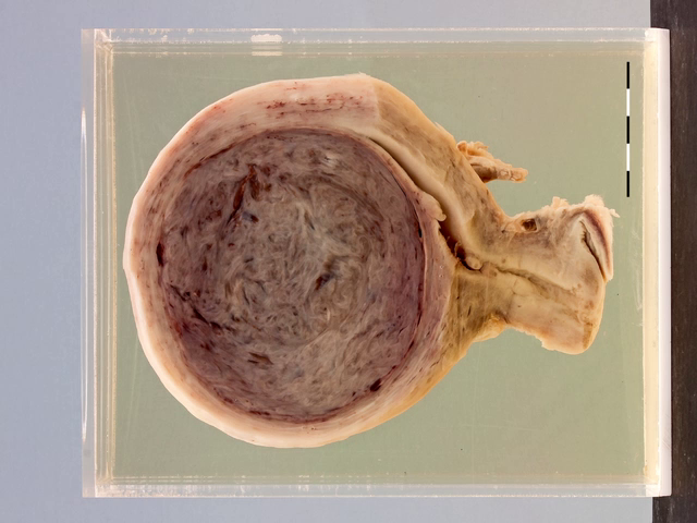 Leiomyoma variants (x3)