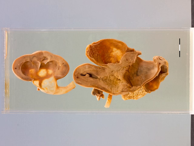 Squamous carcinoma of the cervix