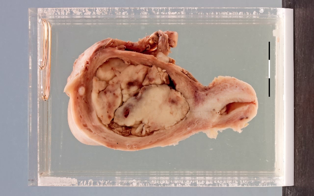 Carcinomasarcoma (MMMT) of the uterus