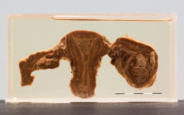 Tuberculous tubo ovarian abscesses