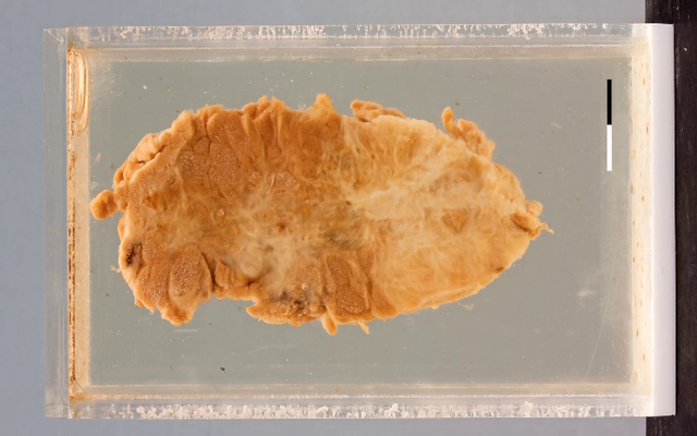 Endometrioma of the abdominal wall