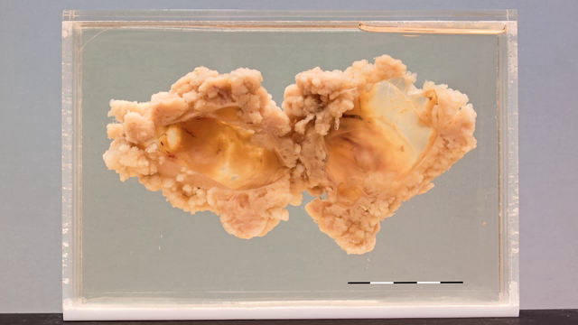 Serous papillary carcinoma of the ovary