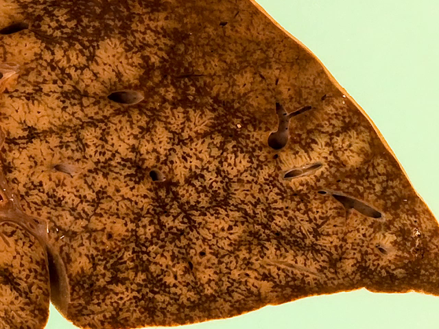 'Nutmeg' liver