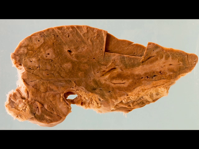Liver with 'pipe stem fibrosis' due to schistosomiasis