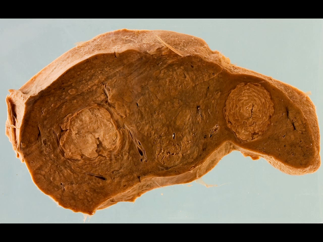 Syphilitic gummas in the liver