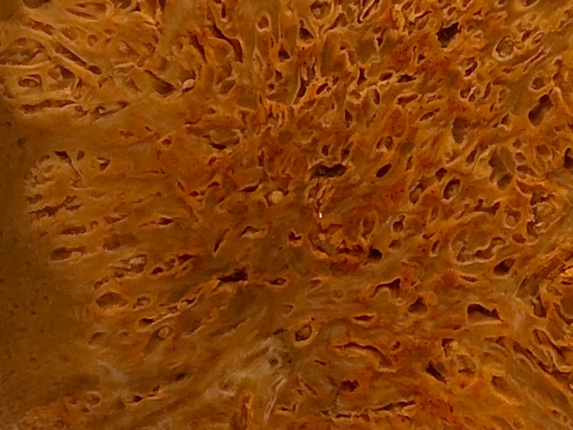 Actinomycotic abscess of the liver