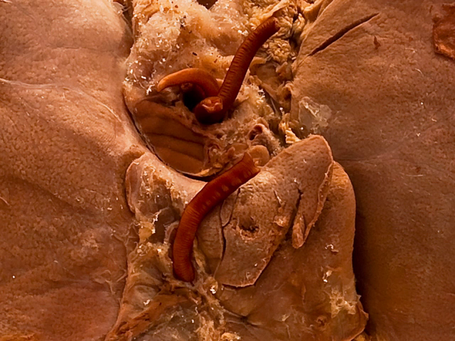Ascaris lumbricoides (Liver)