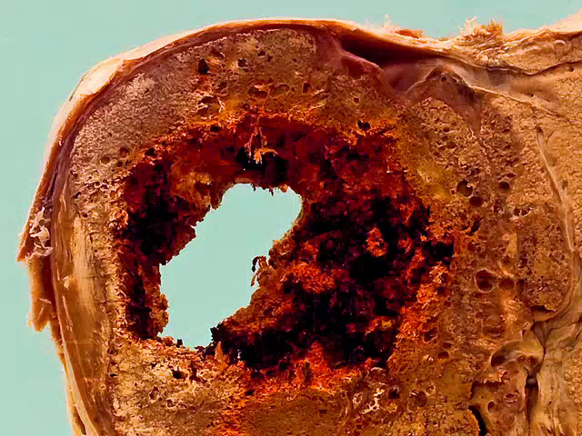 Alveolar hydatid disease (Echinococcus multilocularis)