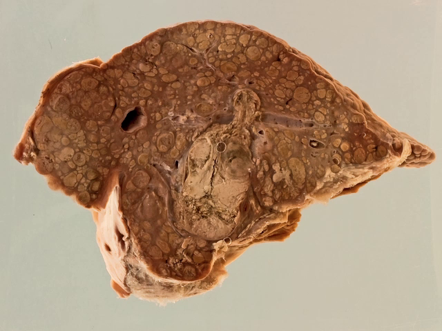 Hepatocellular carcinoma developing in a cirrhotic liver