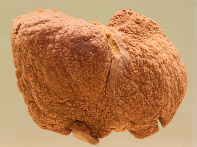 Micronodular cirrhosis