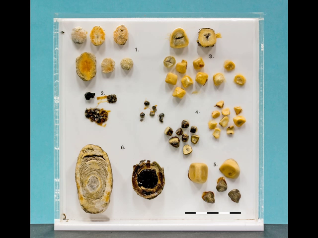 Gallstones