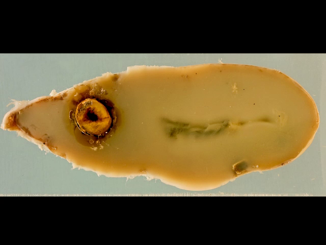 Mucocoele of the gallbladder