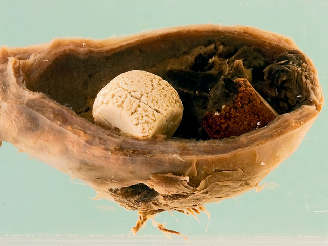 Acute cholecystitis with perforation