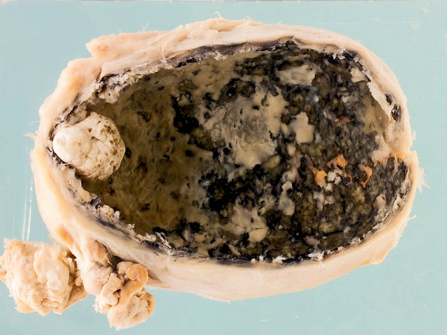 Empyema of the gallbladder