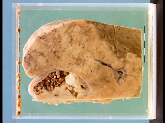 Adenocarcinoma of the gallbladder