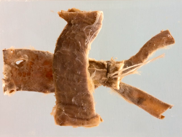 AC Aortic ligation