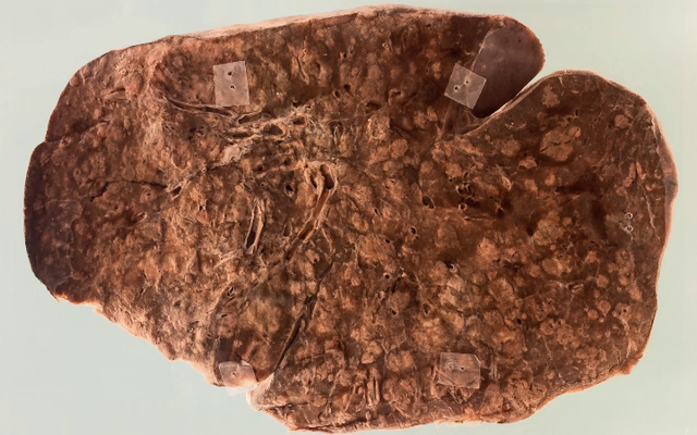 Kaposi sarcoma Lung
