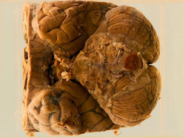 Pseudomonas meningitis following leucotomy