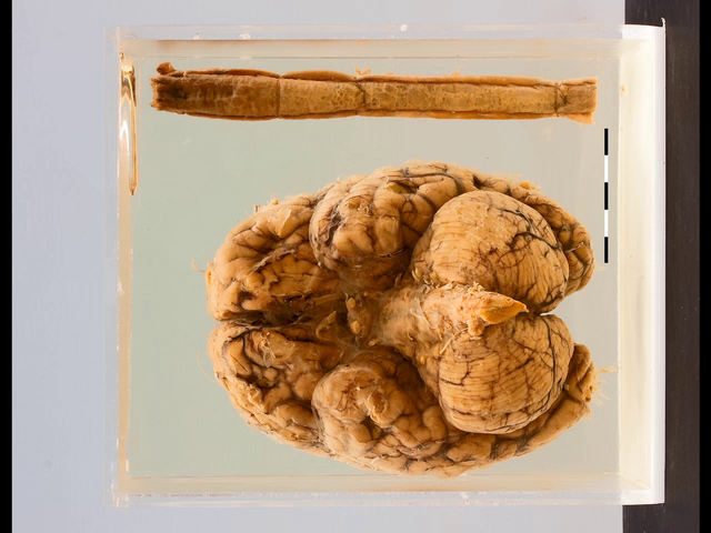 Tuberculous meningitis